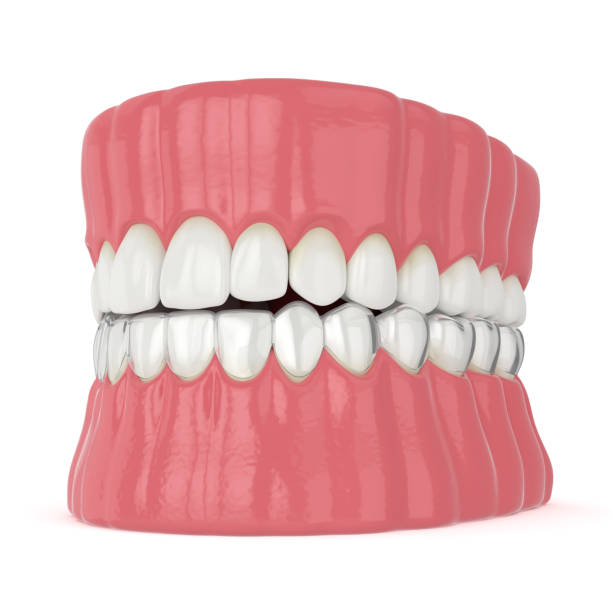 istock 3d render of jaw with invisalign removable retainer 1210031981
