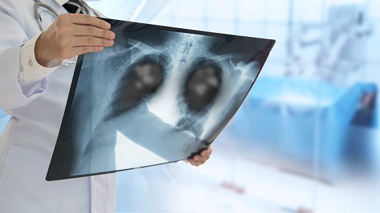 Radiografía del paciente con neumonía photo