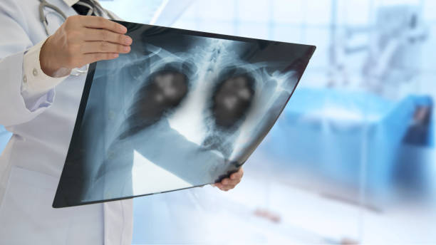 Pneumonia patient x-ray stock photo