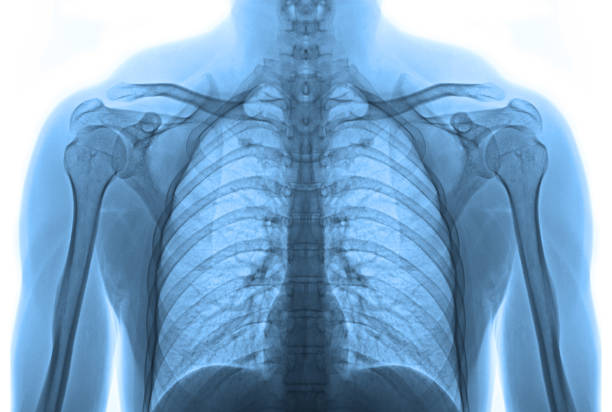 x-ray image body isolated - pain rib cage x ray image chest imagens e fotografias de stock