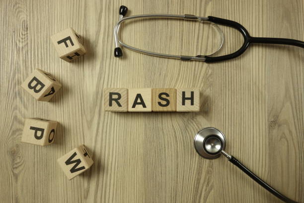 Word rash from wooden blocks with stethoscope Word rash from wooden blocks with stethoscope, healthcare and medical concept erythema nodosum stock pictures, royalty-free photos & images