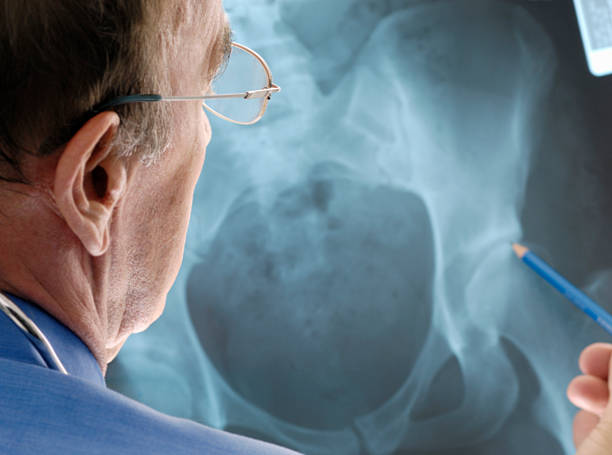 arzt untersuchen osteoporose auf ein x-ray. - hip replacement stock-fotos und bilder