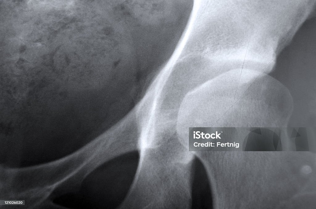 X-ray que representan la osteoporosis de la cadera junta - Foto de stock de Asistencia sanitaria y medicina libre de derechos