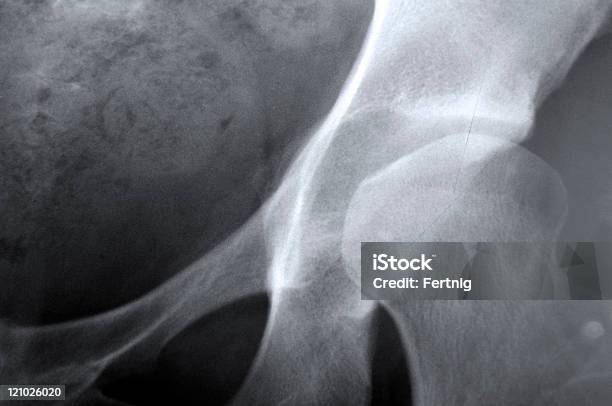 Xray Que Representan La Osteoporosis De La Cadera Junta Foto de stock y más banco de imágenes de Asistencia sanitaria y medicina