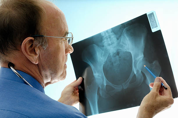 Orthopaedic surgeon consulting pelvic x-rays for a hip replacement. An experienced Caucasian orthopaedic surgeon (doctor) examining a pelvic x-ray displaying signs of osteoporosis - hip degeneration.  Actual x-ray of a 42 year-old woman with a degenerative hip.  The Orthopaedic surgeon is using a pencil to point at the hip where the problem is. This patient is a candidate (real) for hip replacement.  The dominant colour is blue. osteoarthritis photos stock pictures, royalty-free photos & images