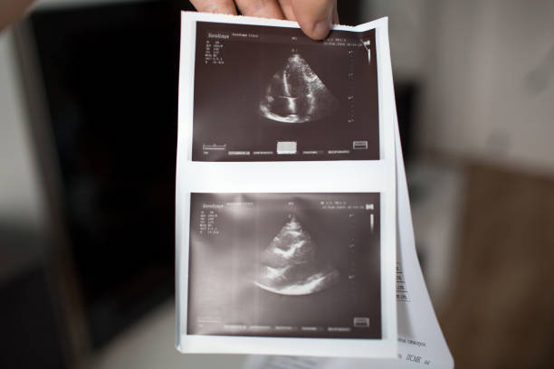 istock Doppler sonography ultrasound heart test 1210271011