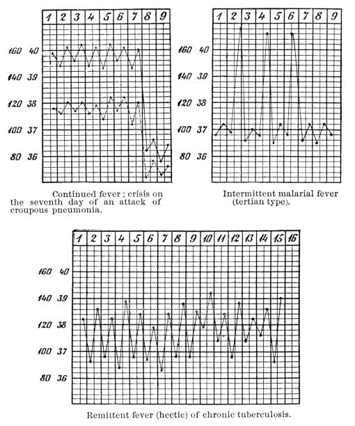 Charts showing the temperature patterns of different types of fever. Vintage etching circa mid 19th century.