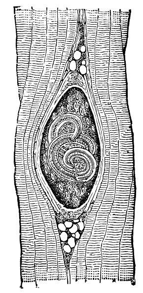 Medical diagram of a muscle with Trichinellosis (an encapsulated Trichinella parasitic worm). Vintage etching circa mid 19th century.