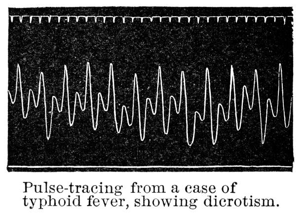 istock Dicrotic Pulse-Trace from a Sphygmograph of a Patient with Typhoid Fever - 19th Century 1210426380