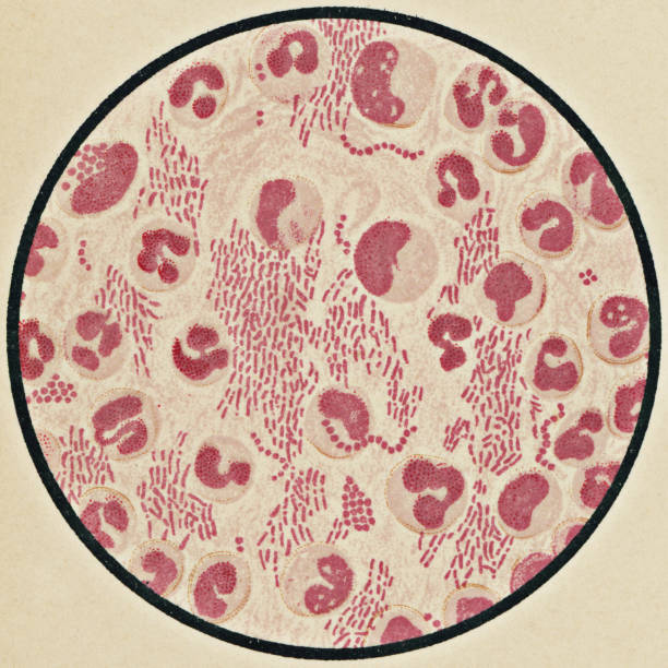 ジフテリア患者からのコリネバクテリウムジフテリアを用いたヒト血液細胞の顕微鏡的見解 - 19世紀 - blood cell formation点のイラスト素材／クリップアート素材／マンガ素材／アイコン素材
