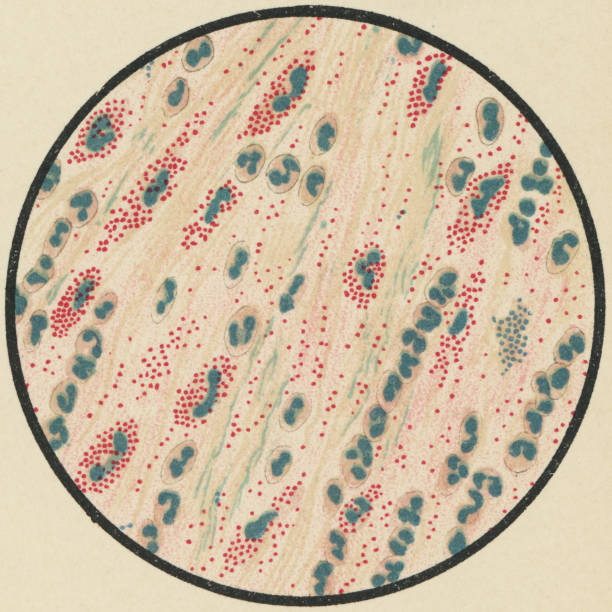 Microscopic View of Eosinophils and Micrococci in Sputum Mucus from a Patient with Asthma, Stained with Methylene Blue and Eosin - 19th Century Microscopic view of eosinophil cells and micrococci bacteria found in sputum mucus from a patient with asthma, stained with methylene blue and eosin. Vintage etching circa mid 19th century. vintage medical diagrams stock illustrations