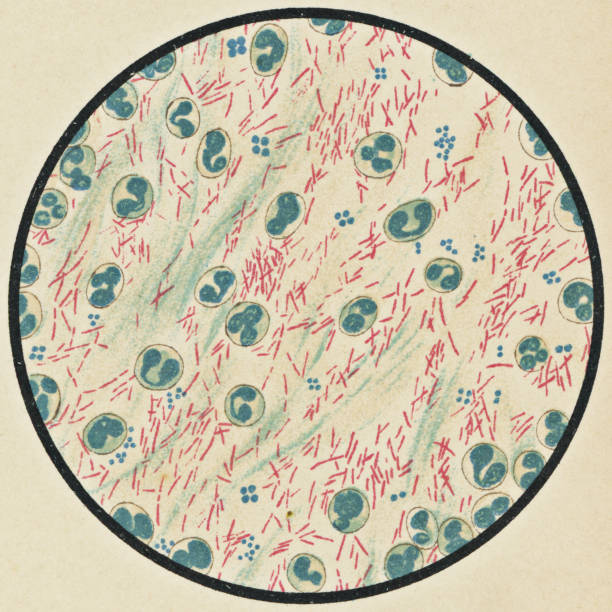 結核患者の結核菌による喀痰粘液の顕微鏡的見解、ziehl-neelsen染色法 - 19世紀 - blood cell formation点のイラスト素材／クリップアート素材／マンガ素材／アイコン素材