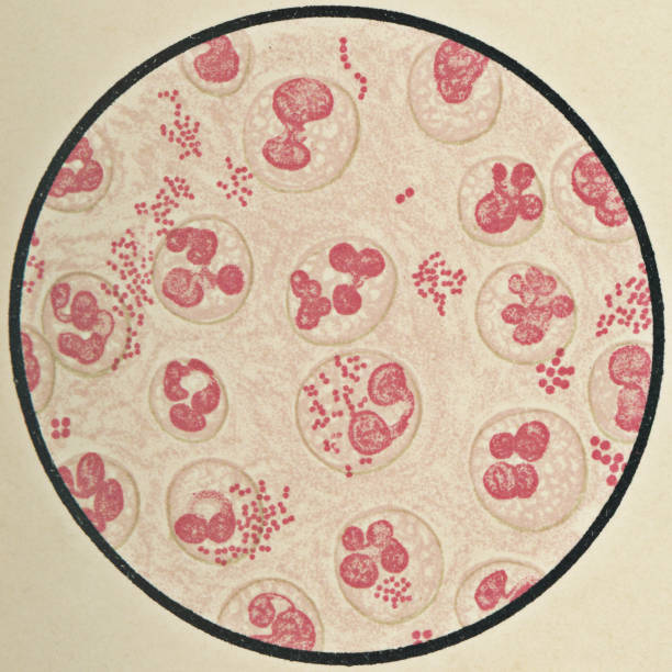 mikroskopijny widok śluzu plwociny z bakteriami grypy od pacjenta z ostrym zapaleniem oskrzeli, barwiony acid fuchsin - 19th century - microscope slide stock illustrations