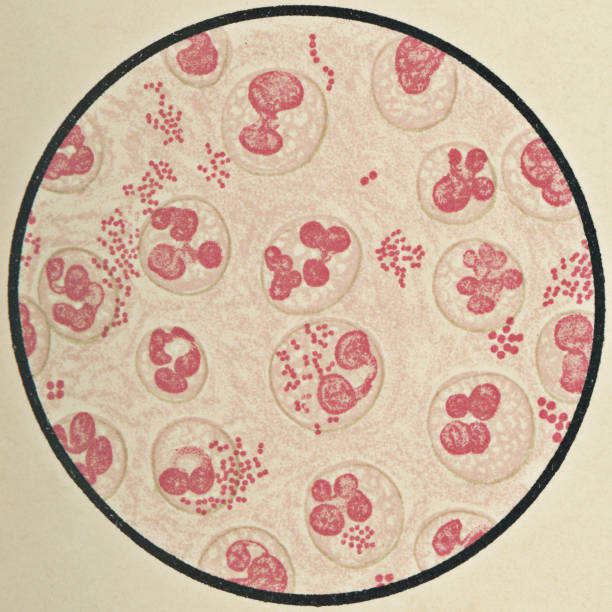 Microscopic View of Sputum Mucus with Influenza Bacteria from a Patient with Acute Bronchitis, Stained with Acid Fuchsin - 19th Century Microscopic view of human blood cells and orthomyxoviridae bacteria (influenza) found in the sputum mucus from a patient with acute bronchitis, stained with acid fuchsin. Vintage etching circa mid 19th century. h1n1 flu virus stock illustrations