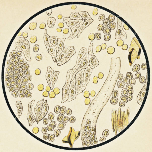 Microscopic View of Human Urinary Sediment from a Patient with Pyelonephritis - 19th Century Microscopic view of human urinary sediment from a patient with pyelonephritis. Vintage etching circa mid 19th century. pyelitis stock illustrations