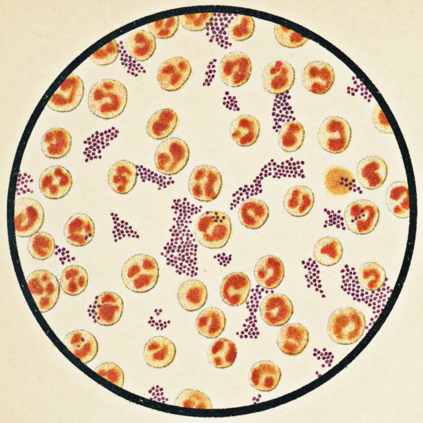 Microscopic View of Human Blood Cells and Staphylococcus Aureus Bacteria from a Patient that Developed a Staph Infection with Typhoid Fever - 19th Century Microscopic view of human white blood cells and staphylococcus aureus bacteria from a patient that developed a staph infection with typhoid fever. Vintage etching circa mid 19th century. staphylococcal enterotoxicosis stock illustrations