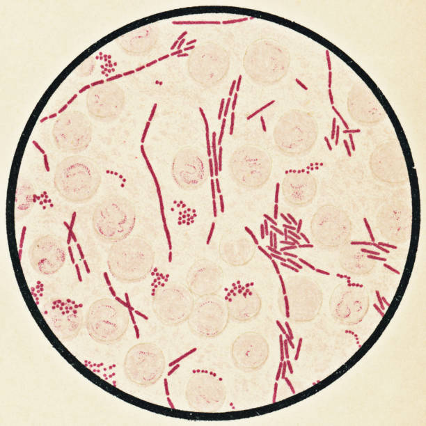 Microscopic View of Human Blood Cells and Proteus Vulgaris Bacteria from a Patient with Peritonitis - 19th Century Microscopic view of human white blood cells and proteus vulgaris bacteria from a patient with peritonitis. Vintage etching circa mid 19th century. Staphylococcus bacteria also present. staphylococcal enterotoxicosis stock illustrations