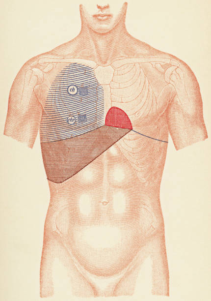 medizinische illustration des menschlichen torso mit stethoskop und percussion-punkte für einen patienten mit lobar pneumonie, frontansicht - 19. jahrhundert - medizinische zeichnung stock-grafiken, -clipart, -cartoons und -symbole