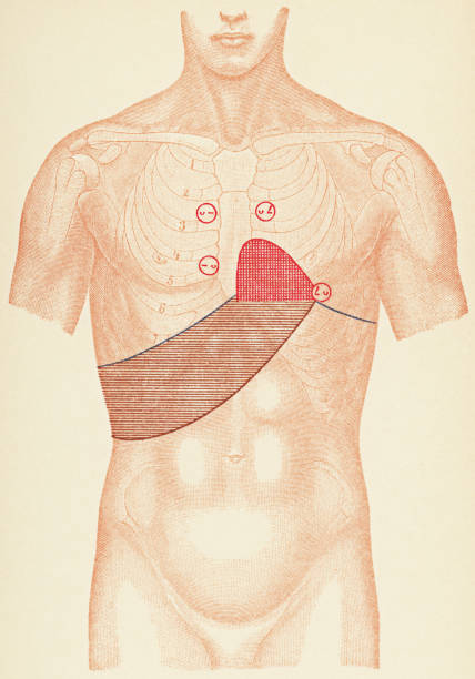 Medical Illustration of Human Torso with Stethoscope and Percussion Points for a Patient with Hypertrophic Cardiomyopathy, Front View - 19th Century Medical illustration of human torso with the placement points for stethoscope and percussion exams for a patient with hypertrophic cardiomyopathy (aortic regurgitation), front view. Vintage etching circa mid 19th century. Circles indicate stethoscope placements and coloured zones for percussion. (u-) represents heart sounds at the base (-u) represents heart sounds at the apex (uL) represents second heart sound accentuated (r) murmurs. vintage medical diagrams stock illustrations
