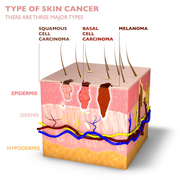 피부 종양, 두더지 및 반점, 피부 층의 3d 단면도 - 기저세포암종 뉴스 사진 이미지
