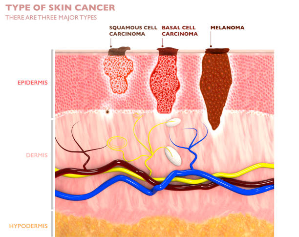 피부 종양, 두더지 및 반점, 피부 층의 3d 단면도 - 기저세포암종 뉴스 사진 이미지