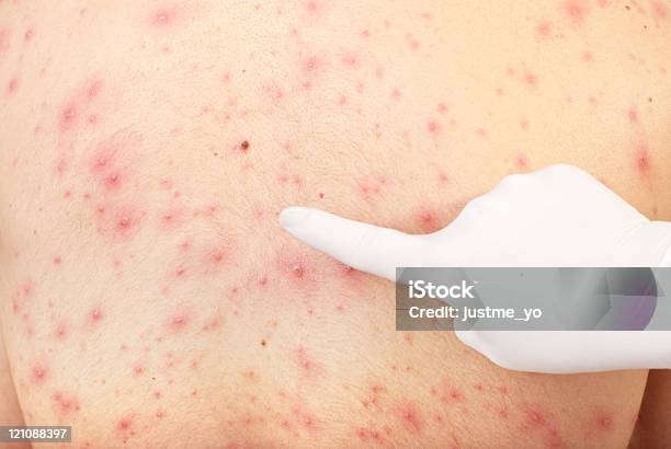 Hand Pointing To Skin Rash Stock Photo - Download Image Now - Chickenpox, Adult, Adults Only