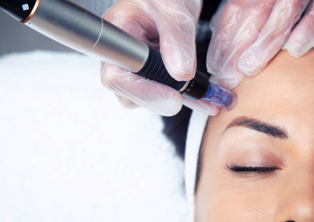 cosmetologist faire l’injection de mésothérapie avec dermapen sur le visage pour le rajeunissement sur le centre de spa. - mesotherapy photos et images de collection