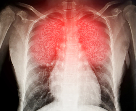 El virus destruye los pulmones humanos que inflama una radiografía photo