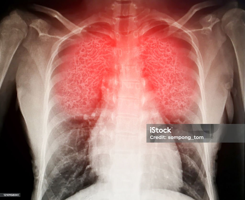 El virus destruye los pulmones humanos que inflama una radiografía - Foto de stock de Pulmón libre de derechos