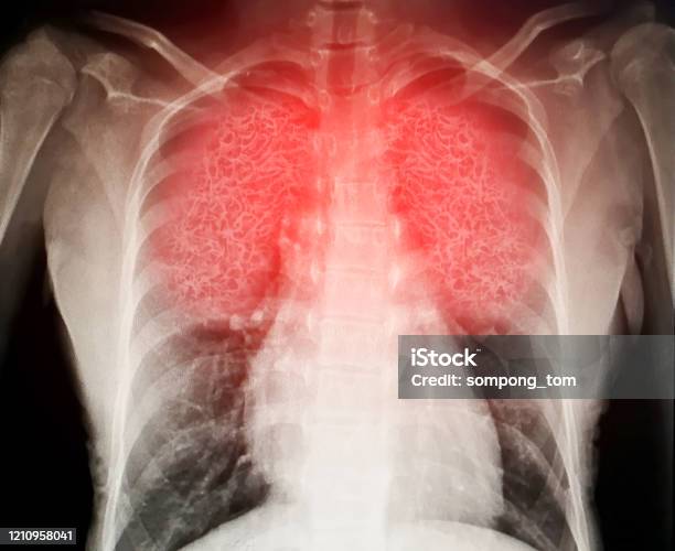 El Virus Destruye Los Pulmones Humanos Que Inflama Una Radiografía Foto de stock y más banco de imágenes de Pulmón