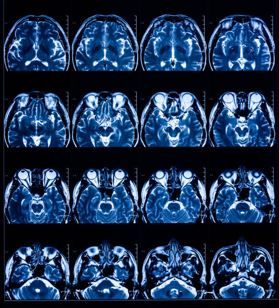 istock MRI scan human head Tomography Top view 1211066668