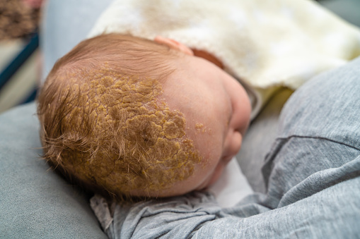 Baby head with dermatologic problem Cradle Cap Seborrheic Dermatitis. The baby is 2 months old and of caucasian ethnicity. The scene is situated indoors in city flat apartment located in Sofia, Bulgaria (Eastern Europe). The picture is taken with Sony A7III camera.