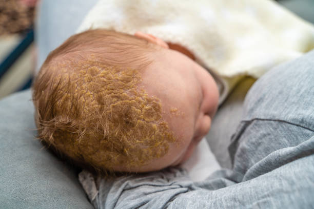 Baby head with dermatologic problem Cradle Cap Seborrheic Dermatitis Baby head with dermatologic problem Cradle Cap Seborrheic Dermatitis. The baby is 2 months old and of caucasian ethnicity. The scene is situated indoors in city flat apartment located in Sofia, Bulgaria (Eastern Europe). The picture is taken with Sony A7III camera. dermatitis photos stock pictures, royalty-free photos & images