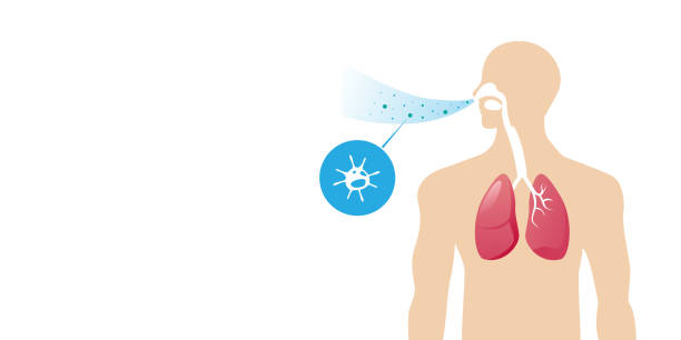 menschlicher körper mit lungen, die von viruszellen betroffen sind bakterien und pilze in die atemwege des menschen aus atmung porträt horizontal - pollenflug stock-grafiken, -clipart, -cartoons und -symbole