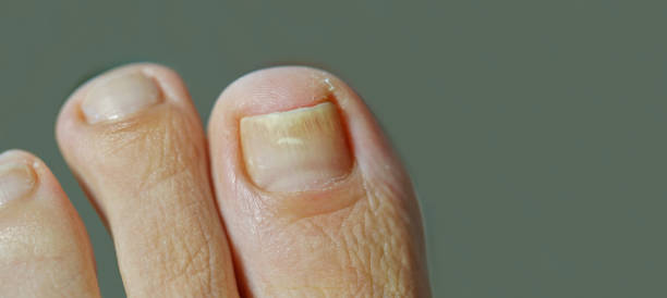 fuß mit nagel psoriasis, onychomykose. frau mit einem eingewachsenen zehennagel. kurz geschnittene nägel. dermatitis - fungus toenail human foot onychomycosis stock-fotos und bilder