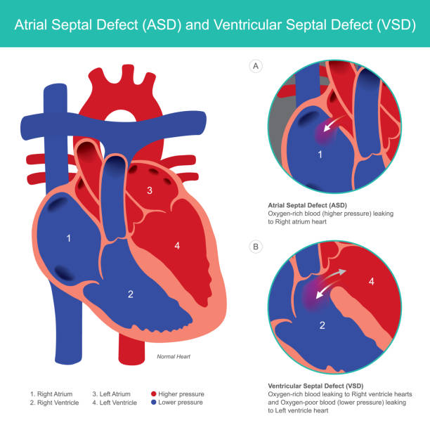 atrial septal defect (asd) and venricular septal defect (vsd). abnormal des herzatrial und herz ventrikel von der geburt des babys. - herzkammer stock-grafiken, -clipart, -cartoons und -symbole