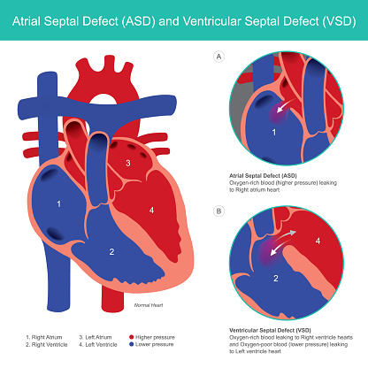 Atrial Septal Defect Abnormal Of The Heart Atrial And Heart Ventricle From  Baby Birth Stock Illustration - Download Image Now - iStock