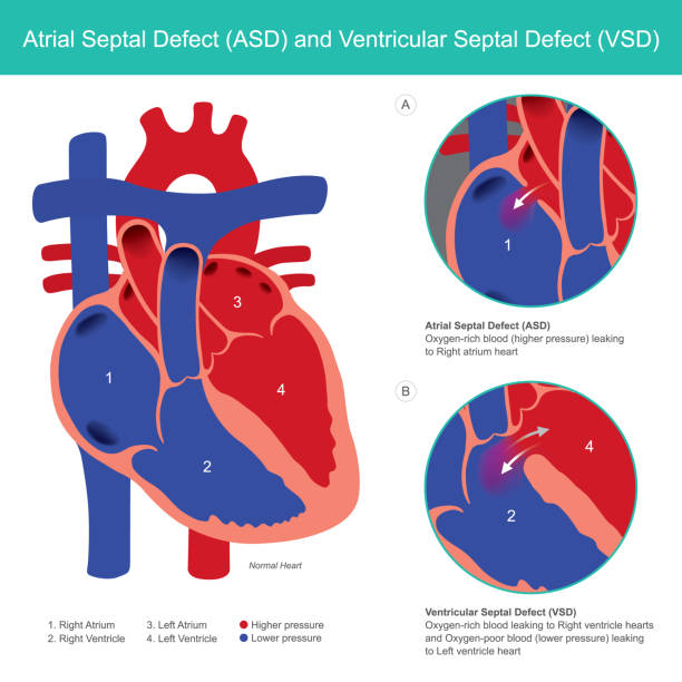 Atrial Septal Defect (ASD) and Ventricular Septal Defect (VSD). Abnormal of the heart atrial and heart ventricle from baby birth. Atrial Septal Defect (ASD) and Ventricular Septal Defect (VSD). Abnormal of the heart atrial and heart ventricle from baby birth. cardiac conduction system stock illustrations