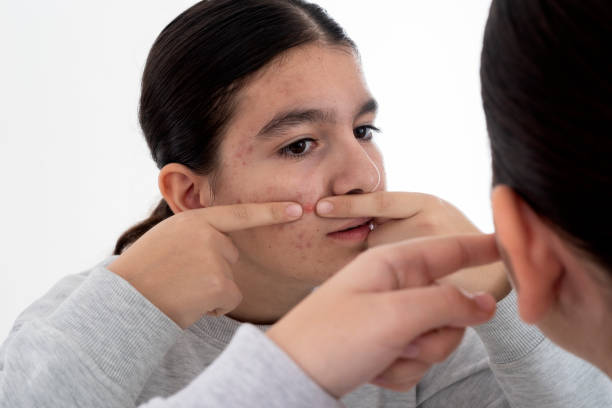 istock teenage girl skin problems during adolescence 1211334062