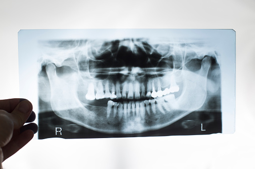 The dentist doctor holds in his hand an x-ray picture of the jaw with false teeth. Dental prosthetics concept with metal-ceramic crowns