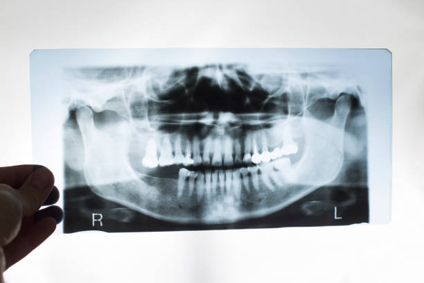 The dentist doctor holds in his hand an x-ray picture of the jaw with false teeth. Dental prosthetics concept with metal-ceramic crowns, periodontium The dentist doctor holds in his hand an x-ray picture of the jaw with false teeth. Dental prosthetics concept with metal-ceramic crowns roentgen stock pictures, royalty-free photos & images