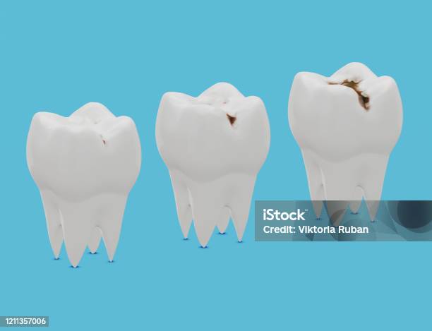 虫歯虫歯の3段階3d イラスト - 歯垢のストックフォトや画像を多数ご用意 - 歯垢, 歯痛, 歯