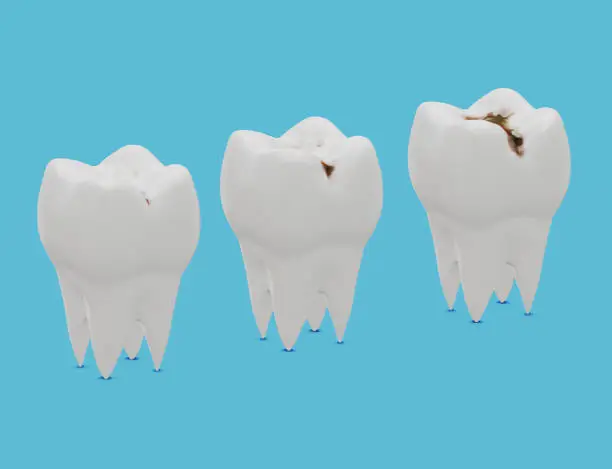 Three stages of tooth decay, caries. 3d illustration