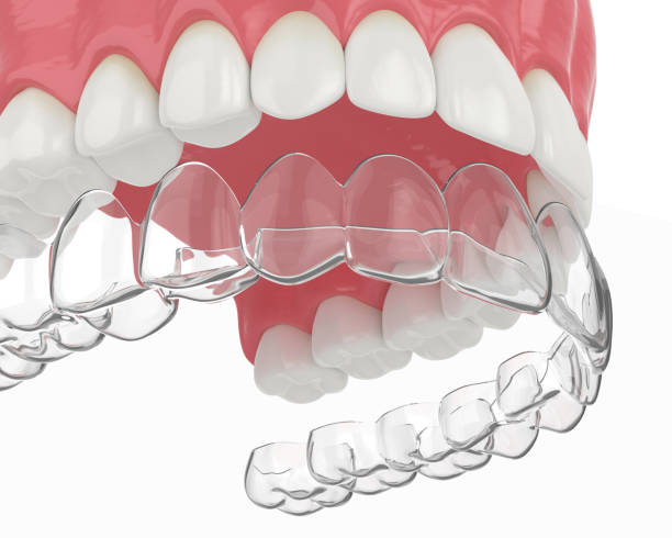 rendering 3d della mascella superiore con fermo rimovibile invisalign - straightener foto e immagini stock