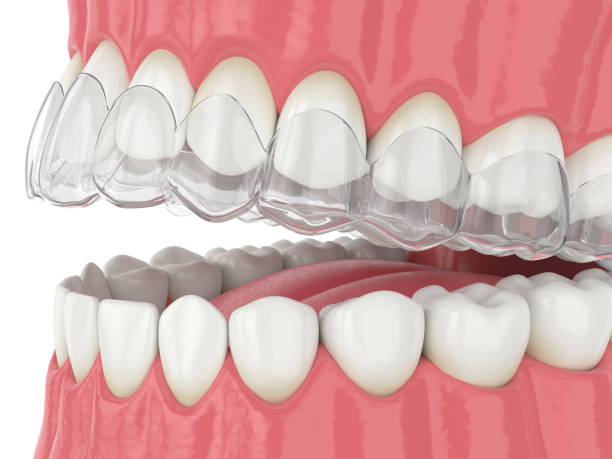 istock 3d render of jaw with invisalign removable retainer 1211379126
