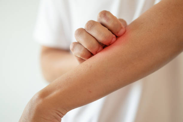istock man itching and scratching on arm from itchy dry skin eczema dermatitis 1211457014
