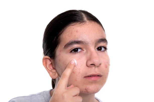 istock teenage girl skin problems during adolescence 1211538599