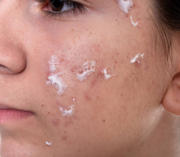 istock teenage girl skin problems during adolescence 1211542506