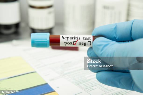 Hepatitis Test Stock Photo - Download Image Now - Hepatitis, Scientific Experiment, Virus