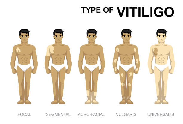 Manga Cartoon Type of Vitiligo Man Set Human Character EPS10 File Format vitiligo stock illustrations
